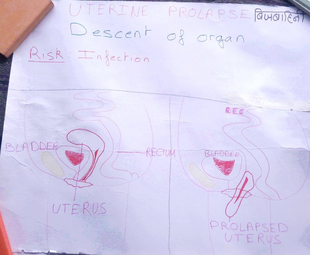Uteral Prolapse